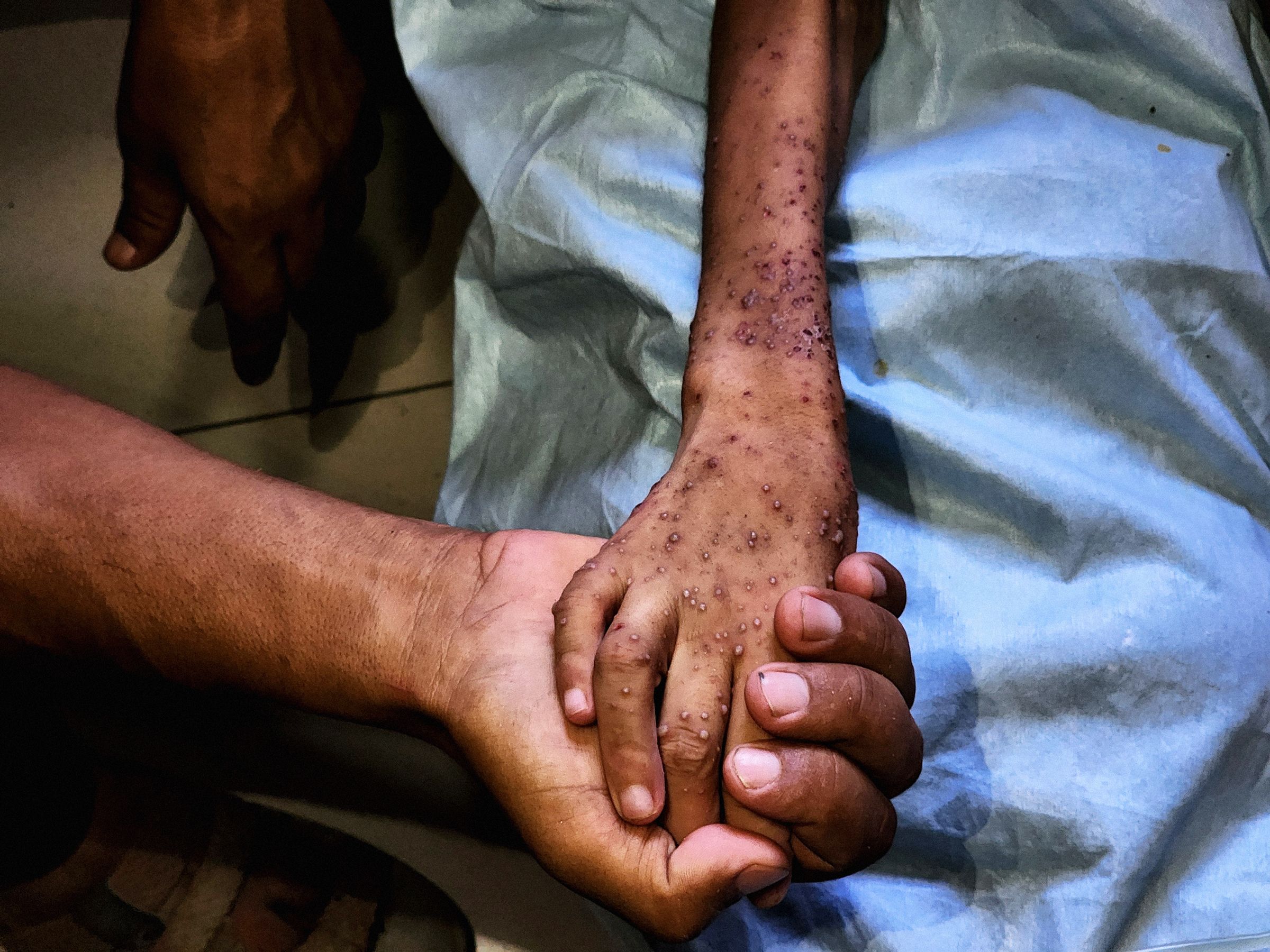 The Grave Long-Term Effects of the Gaza Malnutrition Crisis